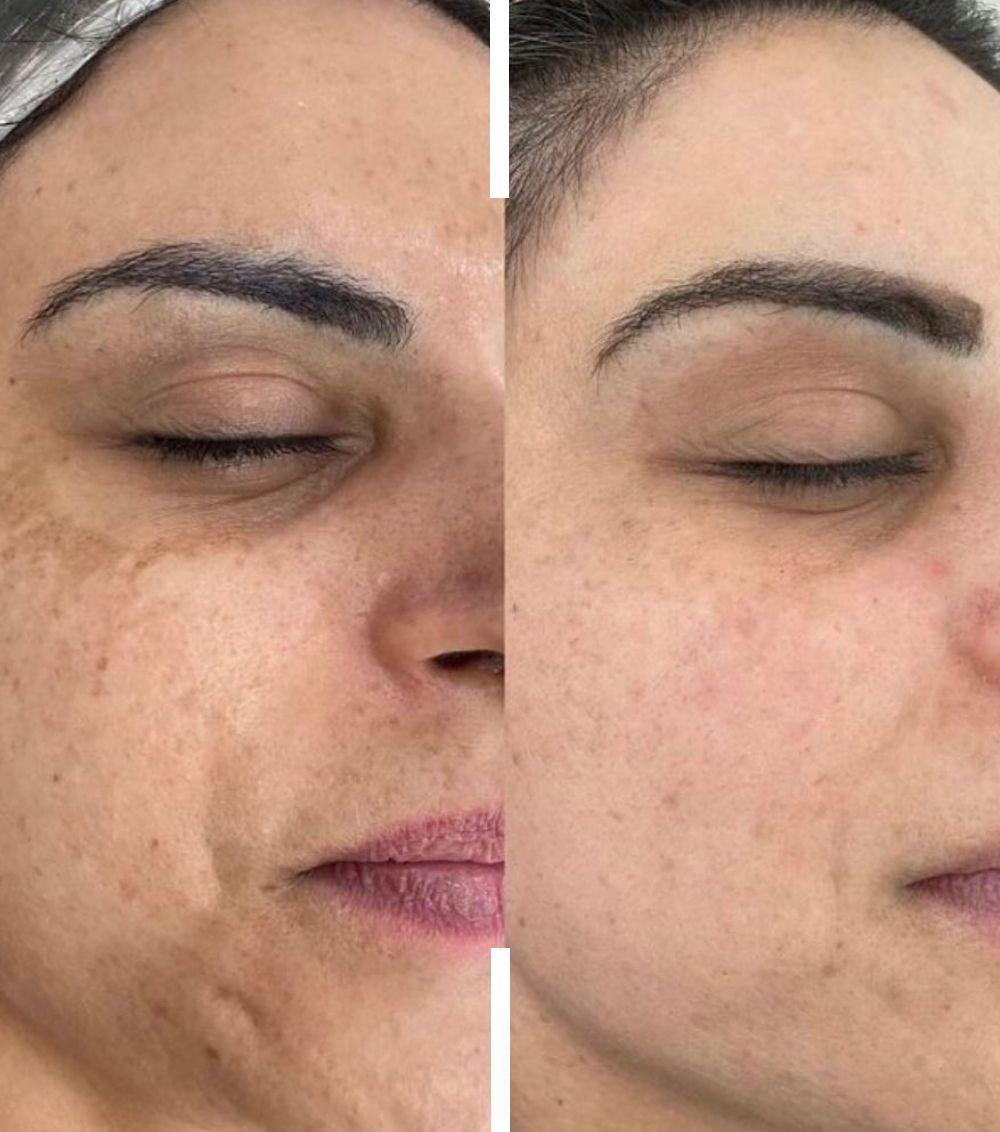 Beauty Procedure - before and after