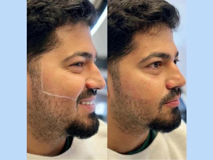 Beauty Procedure - before and after